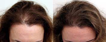 WellnessCave™ Hair Growth Accelerator Soft Chews